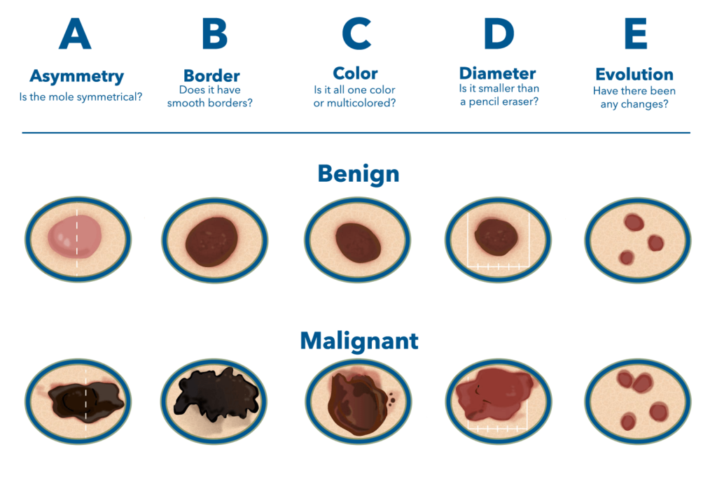 Skin Cancer And Carcinoma Treatment Wny Dermatology