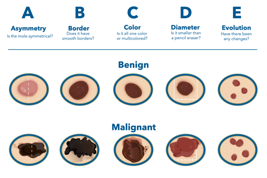 Skin Cancer & Carcinoma Treatment | WNY Dermatology