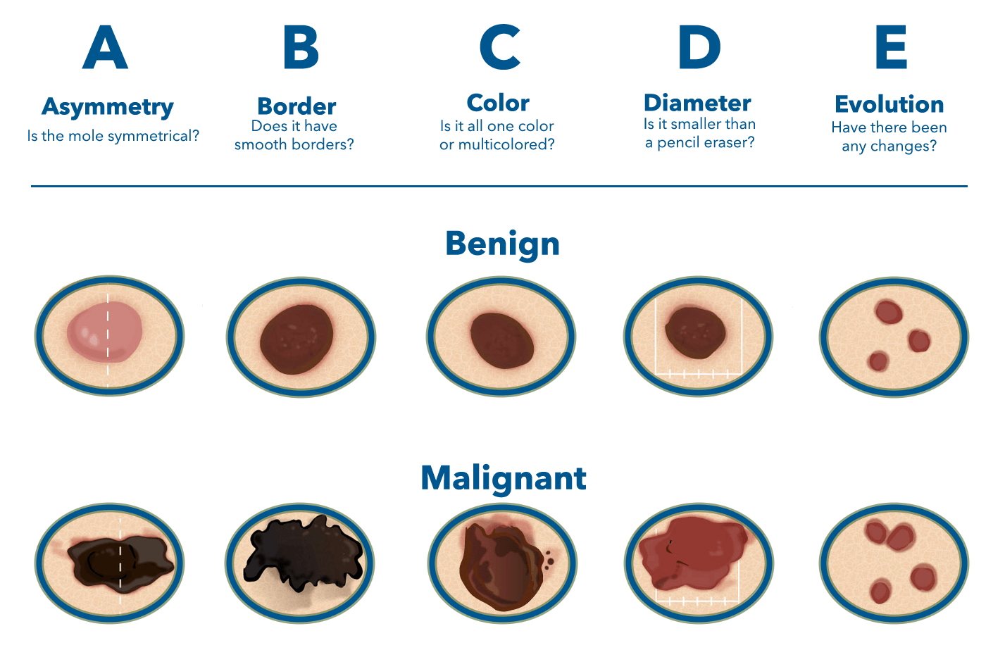 Skin Cancer And Carcinoma Treatment Wny Dermatology