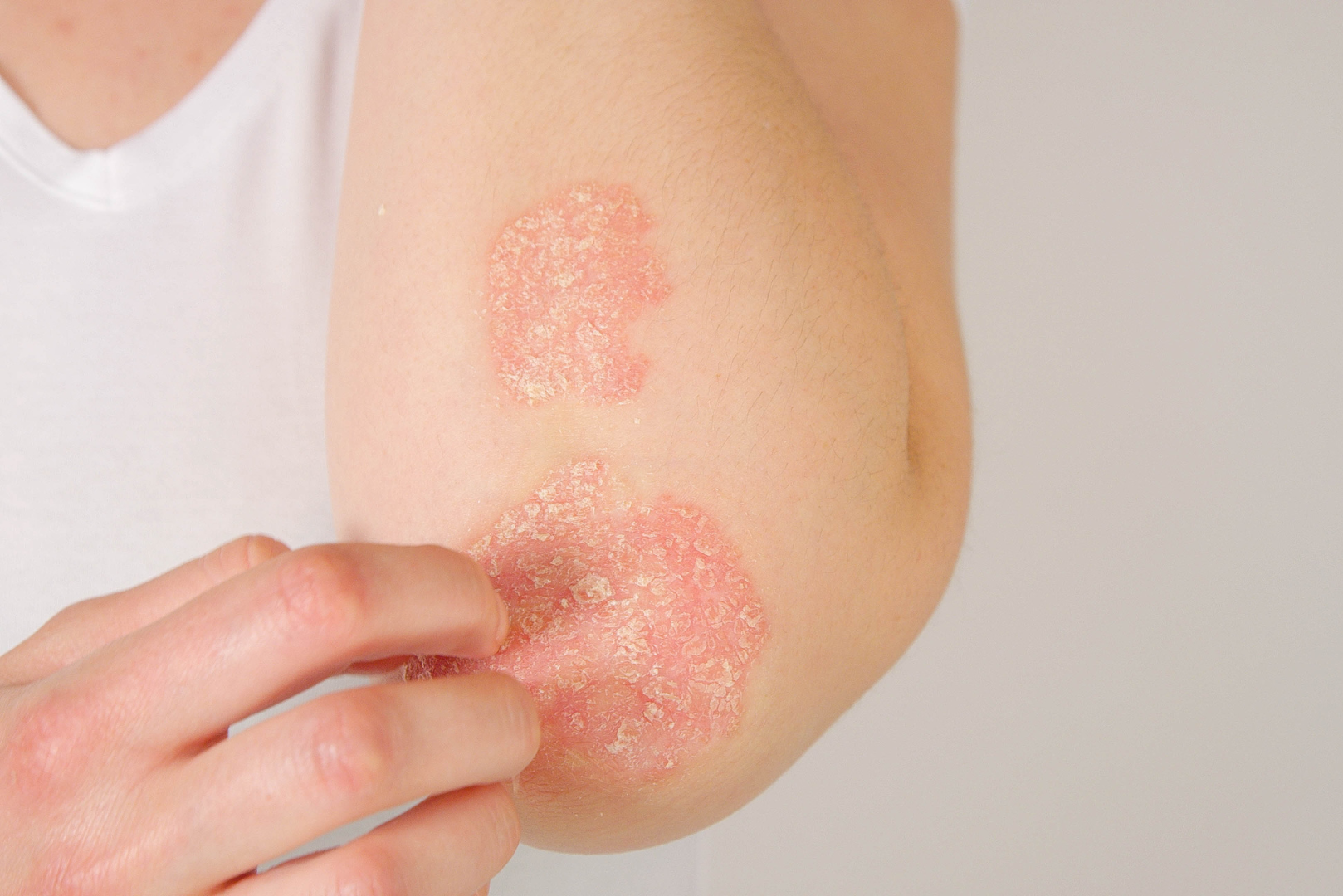 psoriasis skin condition treatments